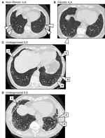 Expanded detection of early fibrotic phenotypes using lobar traction bronchiolectasis in lung cancer screening