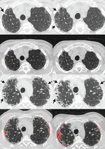 Delineating associations of progressive pleuroparenchymal fibroelastosis in patients with pulmonary fibrosis